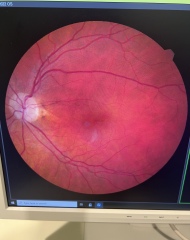 Is the paplidema ?( optic nerve swelling )
