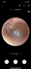 Deafness (including ear pictures)