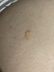 Ringworm or something else?