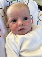 Baby acne or rash? Help please 