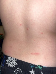 chicken pox ( this will be the 2nd time !) 
