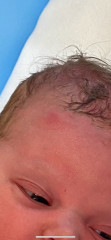 Indent on Babies Forehead