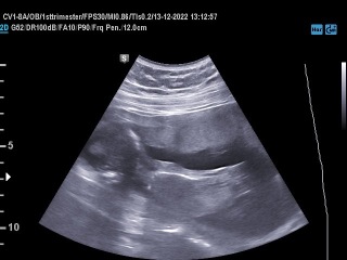 Does this look like low amniotic fluid?