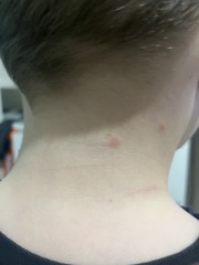 chicken pox ( this will be the 2nd time !) 