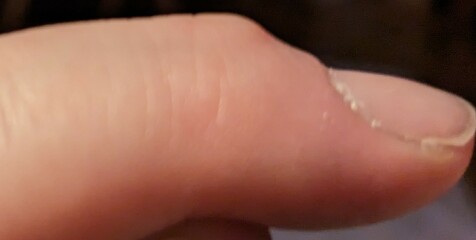 What's this growing on my finger? 