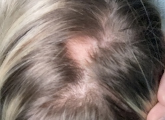 Hair loss … any advice 