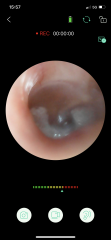 Deafness (including ear pictures)