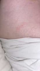 Weird mark on breast 