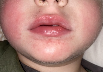 Worried about Strep A outbreak 