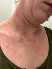 Please help, allergic reaction/scarlet fever or something else. 