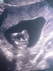 Gender scan experiences? Anyone ever been told wrong?