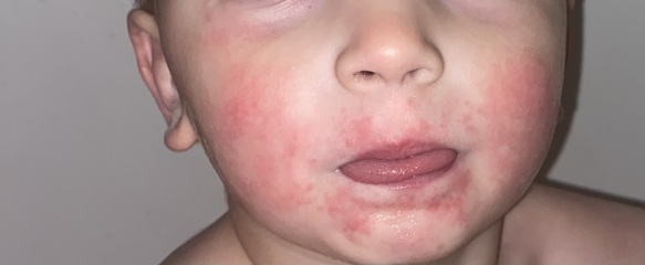 Rash on face