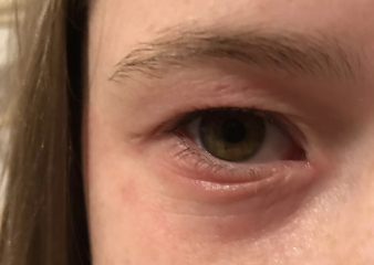 DD (11) has swollen sore eyes that aren't getting better