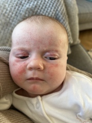 Baby acne or rash? Help please 