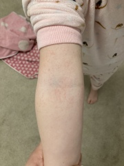 Strep A rash
