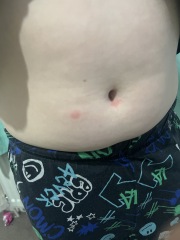 chicken pox ( this will be the 2nd time !) 