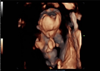 Do you know if this scan is a boy or girl? Gender scan 15 weeks