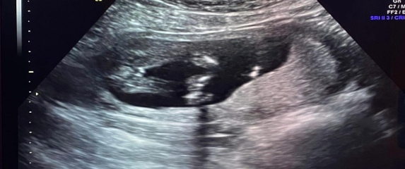 More worries - size & sex of baby 