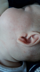 Cmpa rash or baby acne??