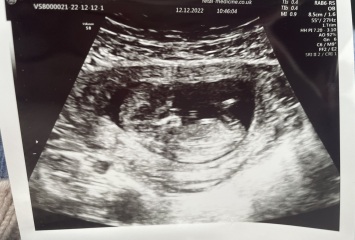 Nub - boy or girl guesses?