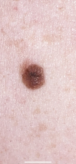 Melanoma what next?