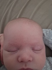 Lump on head? 