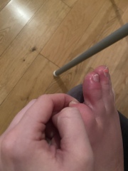 What is wrong with these swelled toes? 