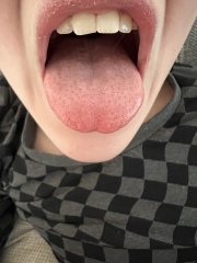Strawberry tongue?