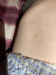 Anyone help with a 3 year olds rash?