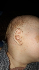 Cmpa rash or baby acne??