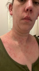 Please help, allergic reaction/scarlet fever or something else. 