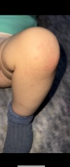 Fast spreading rash and irritability in my 1 year old