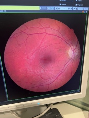 Is the paplidema ?( optic nerve swelling )