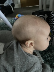 Anyone have experience with Sagittal craniosynostosis?