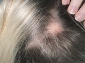 Hair loss … any advice 