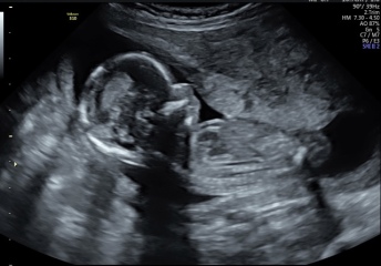 Very early pregnancy and so much anxiety after miscarriage