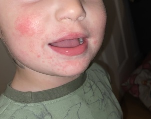 Rash on face