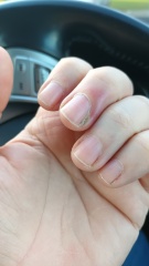 Why won't my goddam finger heal!