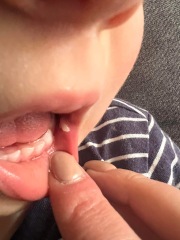 White lump in toddlers mouth