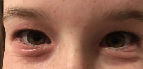DD (11) has swollen sore eyes that aren't getting better