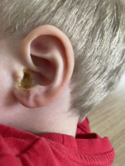 Leaking ear with visible pus.... it stinks bad