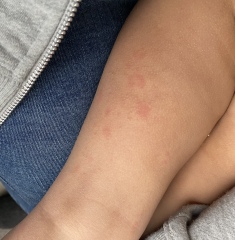 Rash on nearly 3 year old (pics)