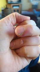 Why won't my goddam finger heal!