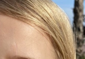 Help! Scar on my LO's face