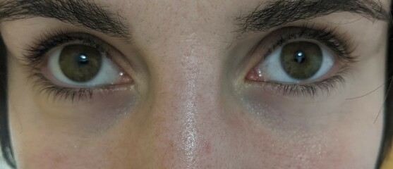 Dark circles under eyes- how to get rid