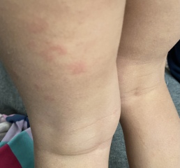 Rash on nearly 3 year old (pics)