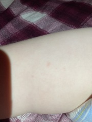 Anyone help with a 3 year olds rash?