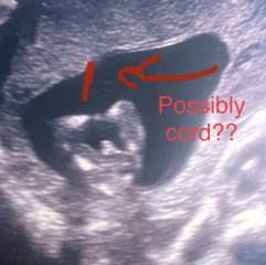 Gender scan experiences? Anyone ever been told wrong?