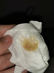 Bronchitis? Warning gross photo!! 
