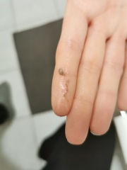 5wks+4 and passing small amounts of tissue for 24hrs - normal? **WARNING PICS INSIDE**